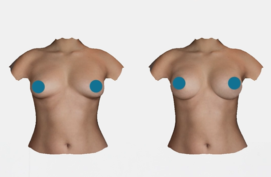 How Does 3D Imaging Change the Plastic Surgery Experience?