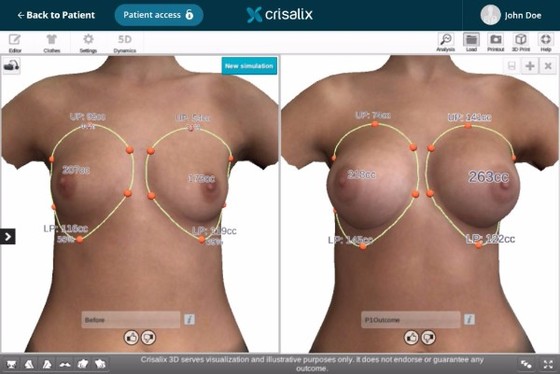 Now you can scan unlimited post-op 3D models for outcome analysis!