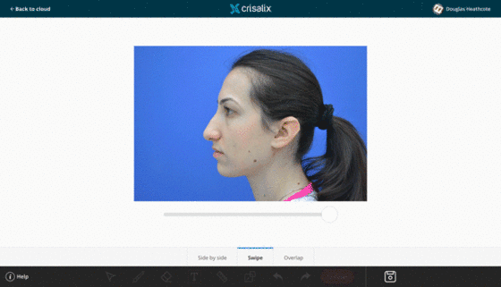 Introducing Crisalix Cloud + Image Editor
