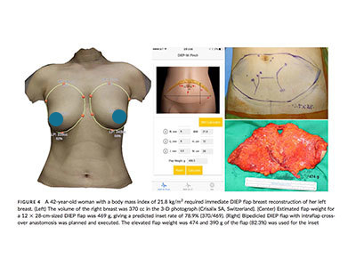 Calculation of pre-operative breast weight using Vectra XT 3D Face and